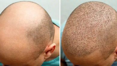 بهترین مراکز کاشت مو در سعادت آباد